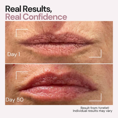 Vynelia | Erase Lip Lines Without Injections in Just 6 Minutes a Day – Made for Mature Lips
