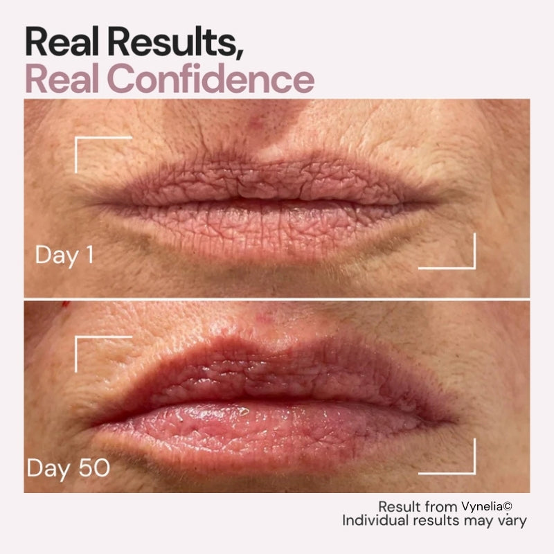 Vynelia | Erase Lip Lines Without Injections in Just 6 Minutes a Day – Made for Mature Lips