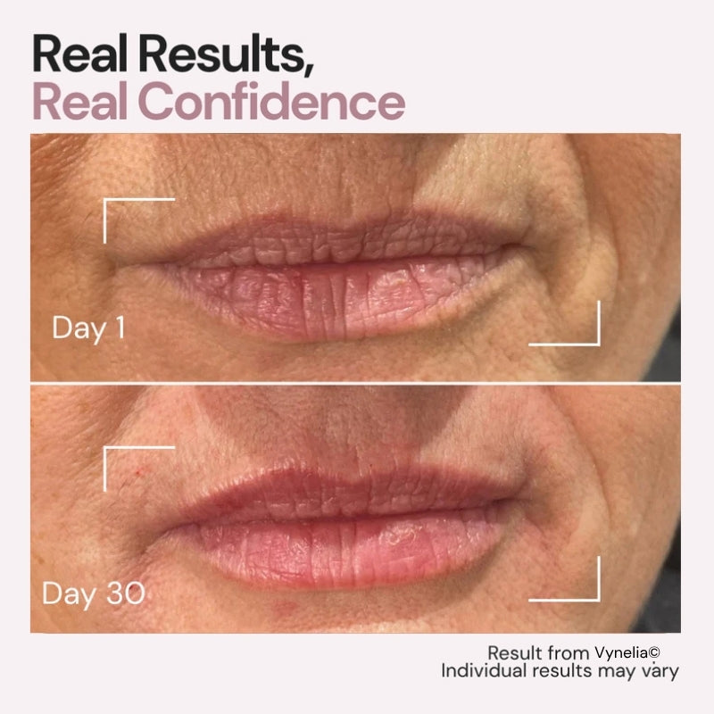 Vynelia | Erase Lip Lines Without Injections in Just 6 Minutes a Day – Made for Mature Lips