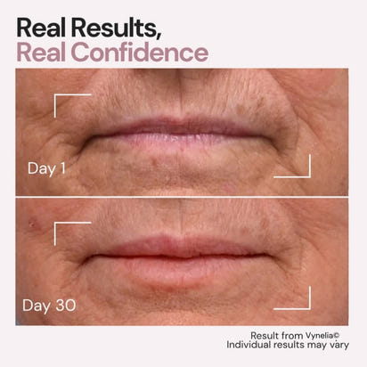 Vynelia | Erase Lip Lines Without Injections in Just 6 Minutes a Day – Made for Mature Lips