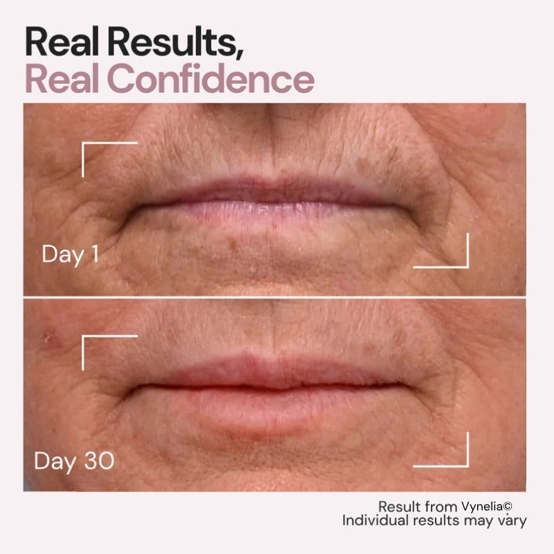 Vynelia | Erase Lip Lines Without Injections in Just 6 Minutes a Day – Made for Mature Lips