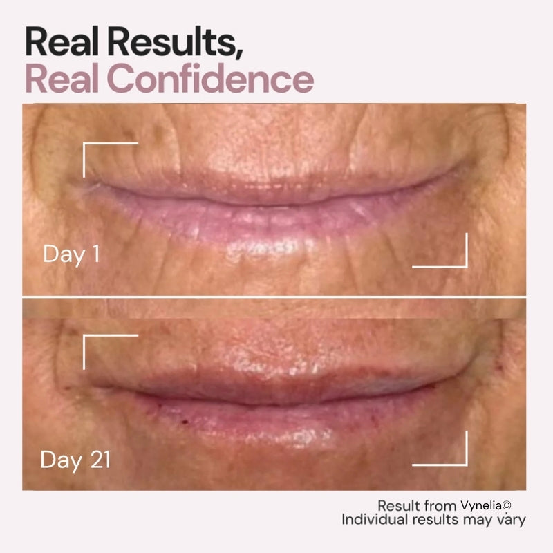 Vynelia | Erase Lip Lines Without Injections in Just 6 Minutes a Day – Made for Mature Lips