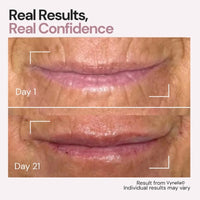 Vynelia | Erase Lip Lines Without Injections in Just 6 Minutes a Day – Made for Mature Lips