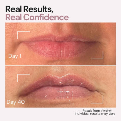 Vynelia | Erase Lip Lines Without Injections in Just 6 Minutes a Day – Made for Mature Lips