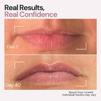 Vynelia | Erase Lip Lines Without Injections in Just 6 Minutes a Day – Made for Mature Lips