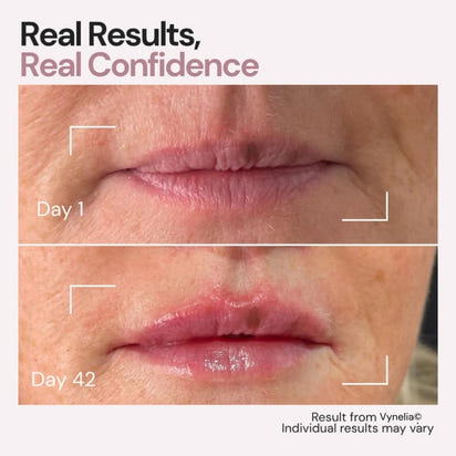 Vynelia | Erase Lip Lines Without Injections in Just 6 Minutes a Day – Made for Mature Lips