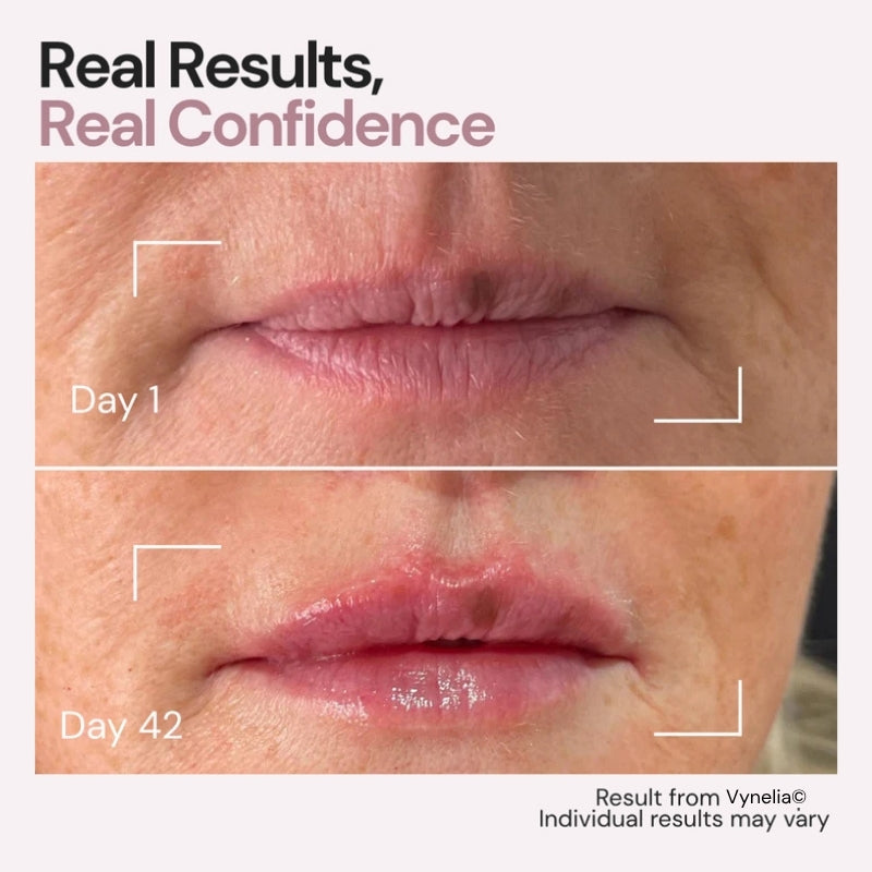 Vynelia | Erase Lip Lines Without Injections in Just 6 Minutes a Day – Made for Mature Lips